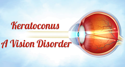 KERATOCONUS- A VISION DISORDER
