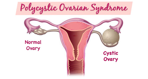 POLYCYSTIC OVARIAN SYNDROME (PCOS)